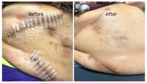 14_days_after_use_of_CRx_notice_surgical_wound_site_is_healing_and_lightening_the_the_scar_and_flattening_the_scar_too._Redness_has_decreased._Used_once_a_day_with_d (2)_3_11zon