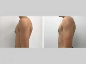 Gynecomastia