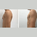 gynecomastia