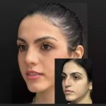 nose surgery in dubai
