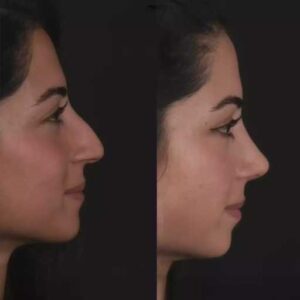 septoplasty in dubai