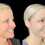 H1-Botox