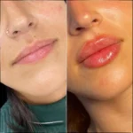 H2-lip-fillers (1)