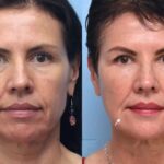 Is Botox Right for You? Insights from the Best Aesthetic Clinics in Dubai