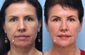 Is Botox Right for You? Insights from the Best Aesthetic Clinics in Dubai