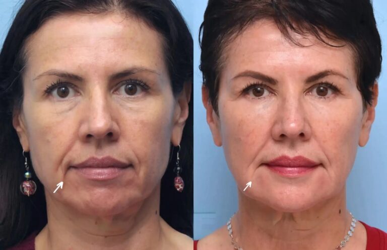 Is Botox Right for You? Insights from the Best Aesthetic Clinics in Dubai
