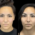 Botox in dubai