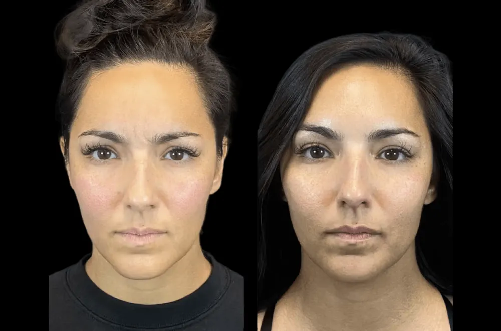 Botox in dubai