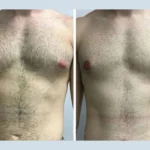 How Climate and Lifestyle Impact Recovery from Gynecomastia Surgery in Dubai