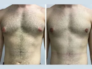 How Climate and Lifestyle Impact Recovery from Gynecomastia Surgery in Dubai