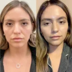 Healing Timeline for Thread Lift in Dubai Explained