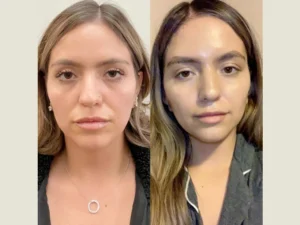 Healing Timeline for Thread Lift in Dubai Explained