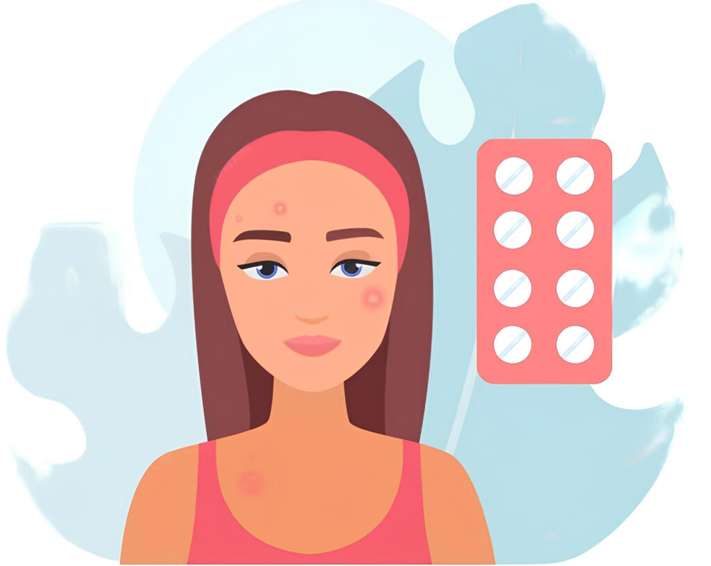 Best Antibiotics for Acne Caused by Bacterial Infections