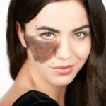 Birthmarks Removal Treatment in Dubai