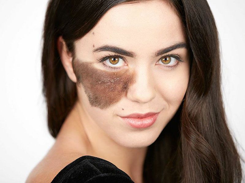 Birthmarks Removal Treatment in Dubai