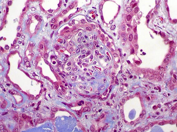 Infantile Nephrotic Syndrome