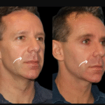 Sculptra Fillers in Dubai