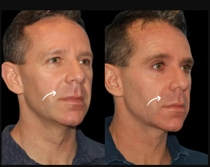 Sculptra Fillers in Dubai