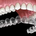 Teeth Straightening