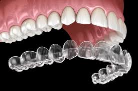 Teeth Straightening