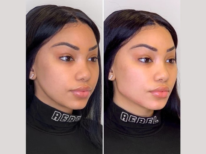 Best Clinics Offering Thread Lift in Dubai