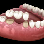 dental crown