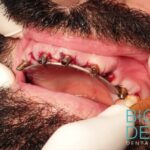 apparecchio trasparente prezzo allineatori dentali invisibili