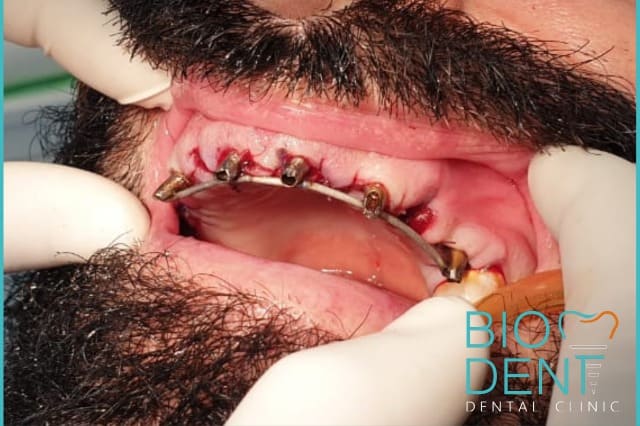 apparecchio trasparente prezzo allineatori dentali invisibili