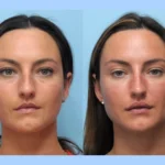 Achieve Long-Lasting Results with Thread Lift Treatment in Dubai