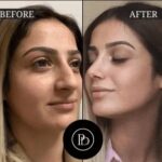Discover the Power of PRP Treatment in Dubai