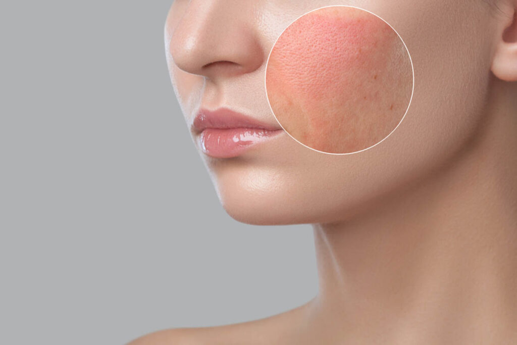 Best masks to use for large pores treatment