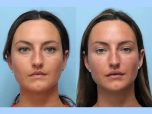 Thread Lifts for a Natural Lift: Why the Best Doctors in Dubai Choose This Non-Surgical Option