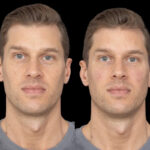 Under Eye Fillers in Dubai