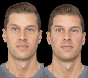 Under Eye Fillers in Dubai