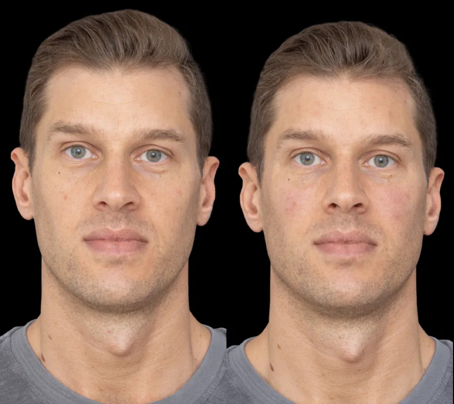 Under Eye Fillers in Dubai