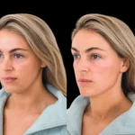 Cheek-Fillers in Dubai