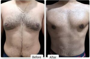 male chest fat surgery in Islamabad