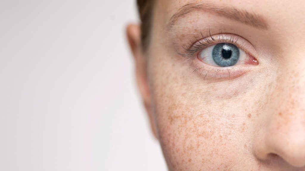 Melasma Treatment: Benefits Beyond Skin Tone