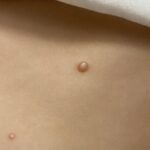 Preparing for Your First Warts Removal Surgery