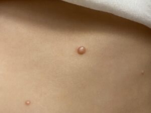 Preparing for Your First Warts Removal Surgery