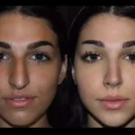 Septoplasty in Dubai