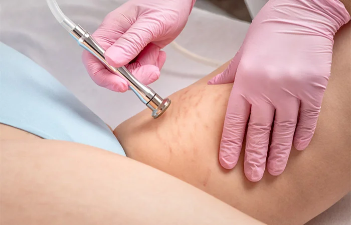 Stretch Marks Removal: When to Start Treatment