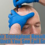 FUE Hair Transplant Results