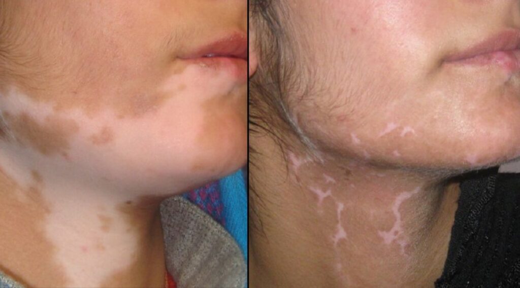 Vitiligo Treatment