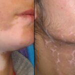 Vitiligo Treatment
