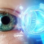 Glaucoma Laser Surgery