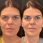 Best Aesthetic Clinics in Dubai Reveal the Long-Term Perks of a Thread Lift