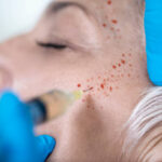 prp-treatment