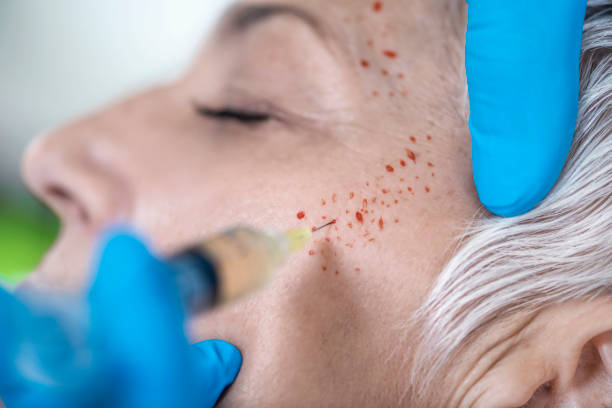 prp-treatment