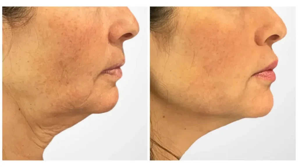 Thread Lift in Dubai: The Best Way to Achieve a Non-Invasive Face Lift